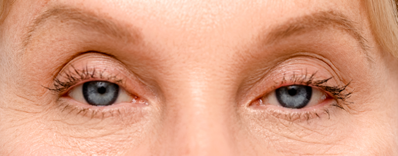 Photo of before Upneeq® Ptosis Low-Lying Lids Treatment at SkyBalance Med Spa in Schaumburg, Illinois