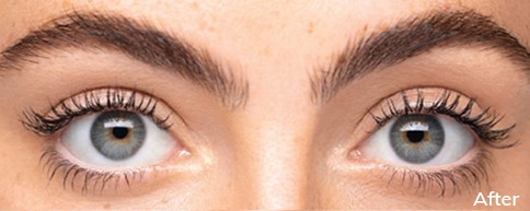 Photo of after Upneeq® Ptosis Low-Lying Lids Treatment