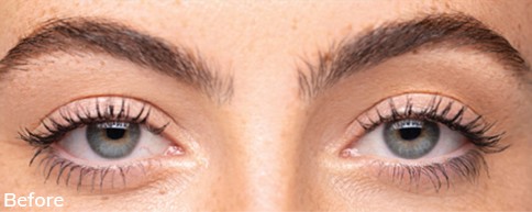 Photo of before Upneeq® Ptosis Low-Lying Lids Treatment